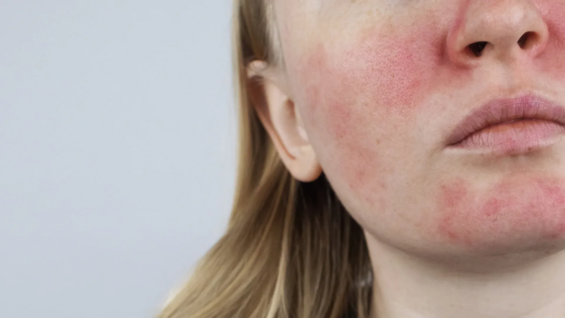 Det överraskande sambandet mellan SIBO och rosacea