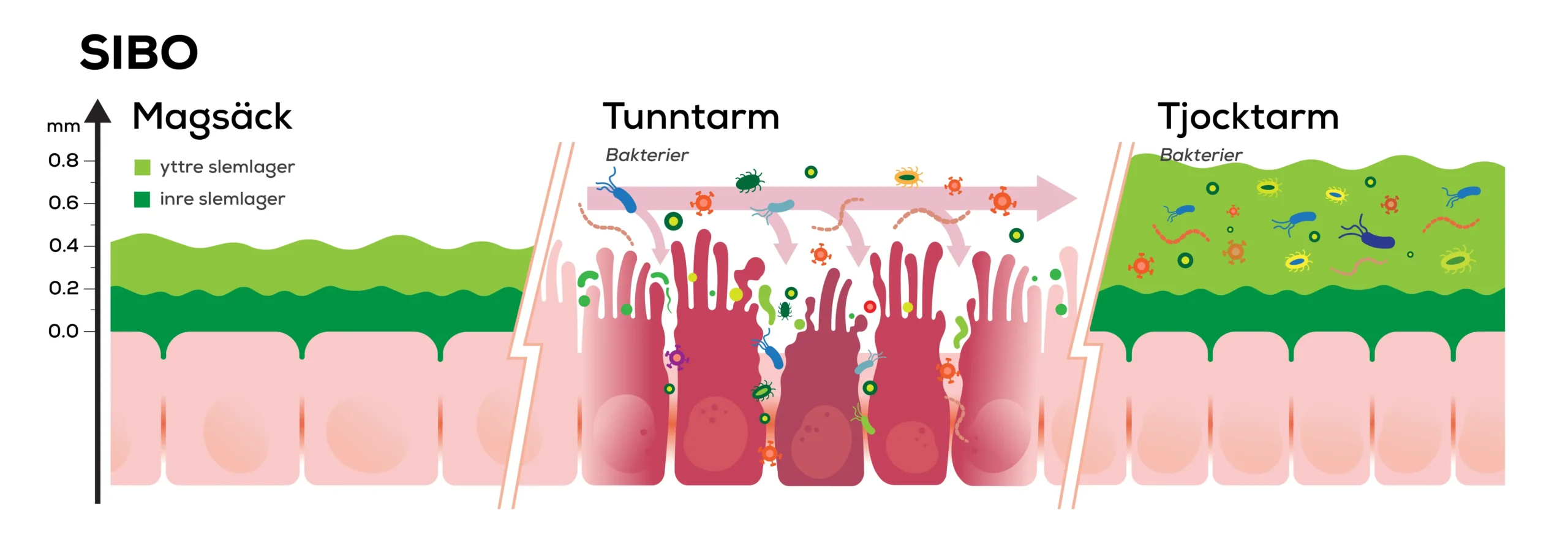 Illustration av slemlager och bakteriefördelning i matsmältningskanalen vid SIBO (Small Intestinal Bacterial Overgrowth).