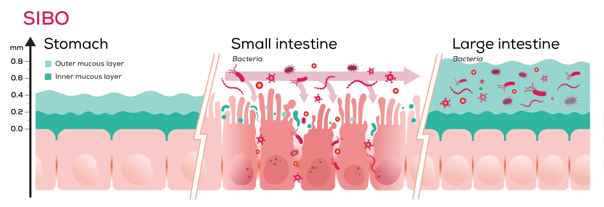 Illustration explaining SIBO and intestinal barrier function