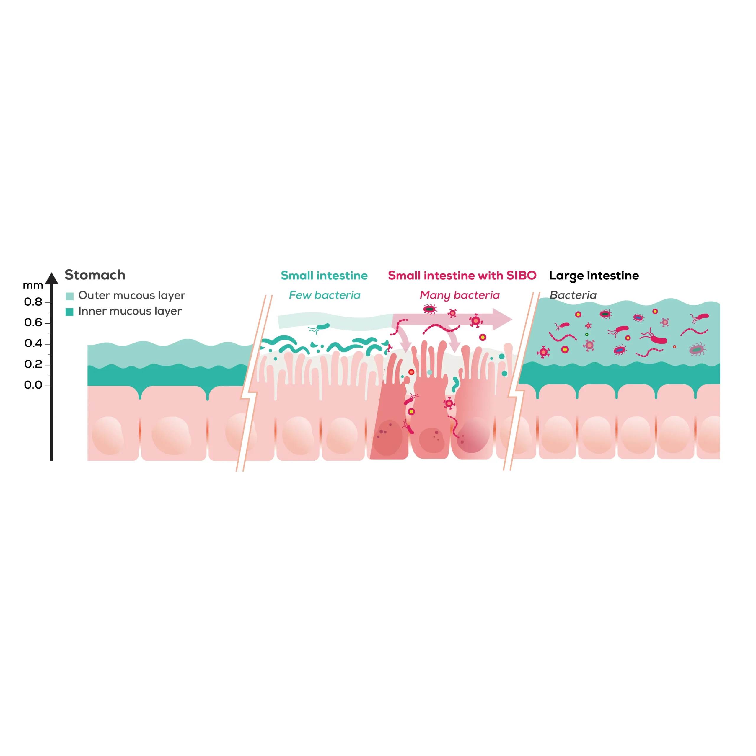 Illustration explaining leaky gut and intestinal permeability